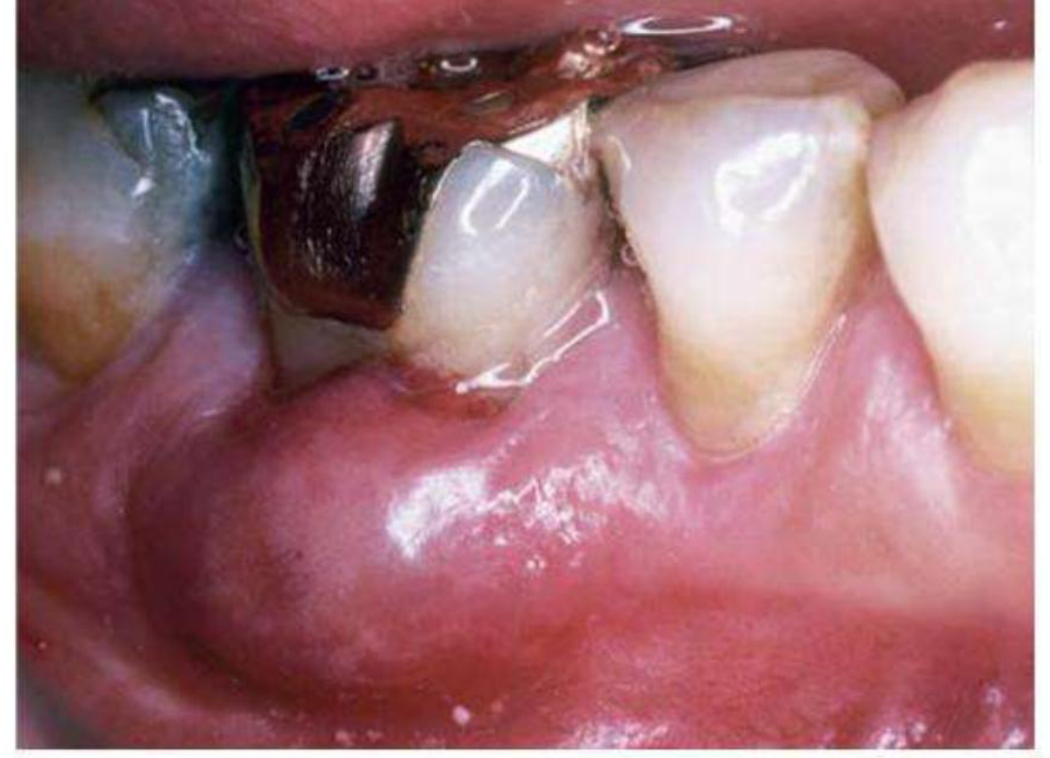 Fig. 38.24 Periodontal abscess associated with a furcation-involved mandibular molar.