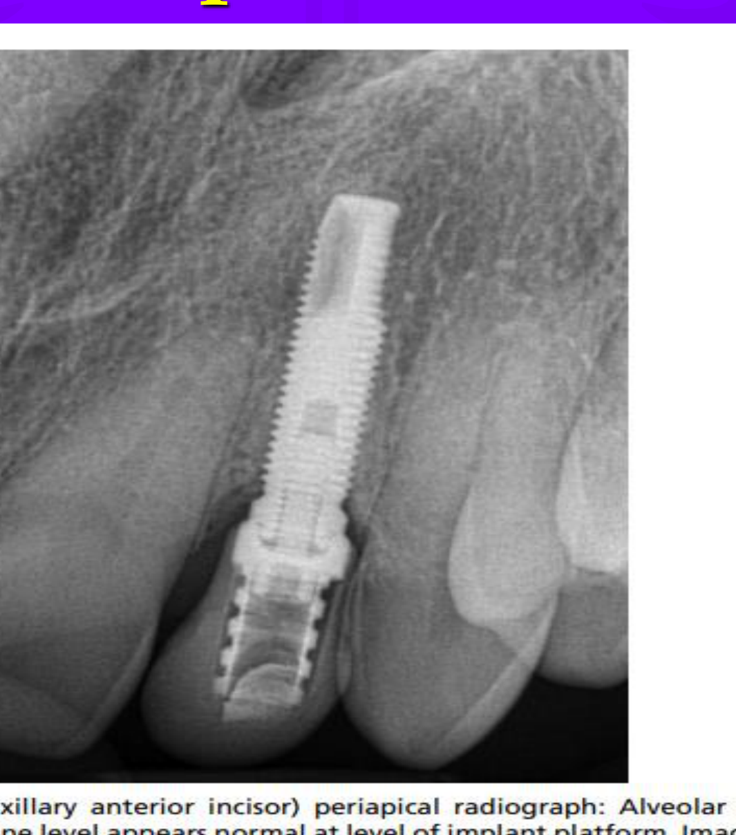 Fig. 23. Mucositis (maxillary anterior incisor) periapical radiograph: Alveolar crest levels appear radiopaque. Bone level appears normal at level of implant platform. Image provided by authors.