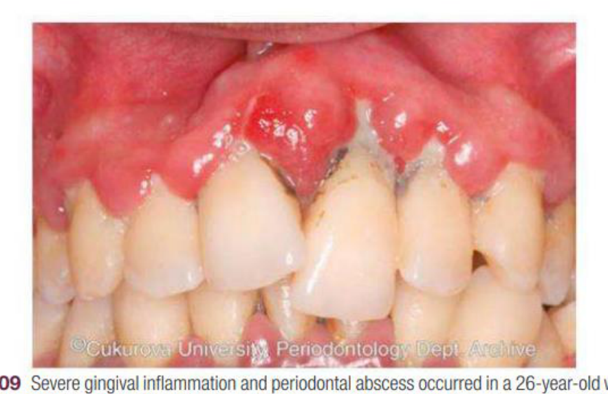 eFig. 7.109 Severe gingival inflammation and periodontal abscess occurred in a 26-year-old woman with type 1 diabetes mellitus. Notice the extrusion of the maxillary left central incisor caused by alveolar bone loss.