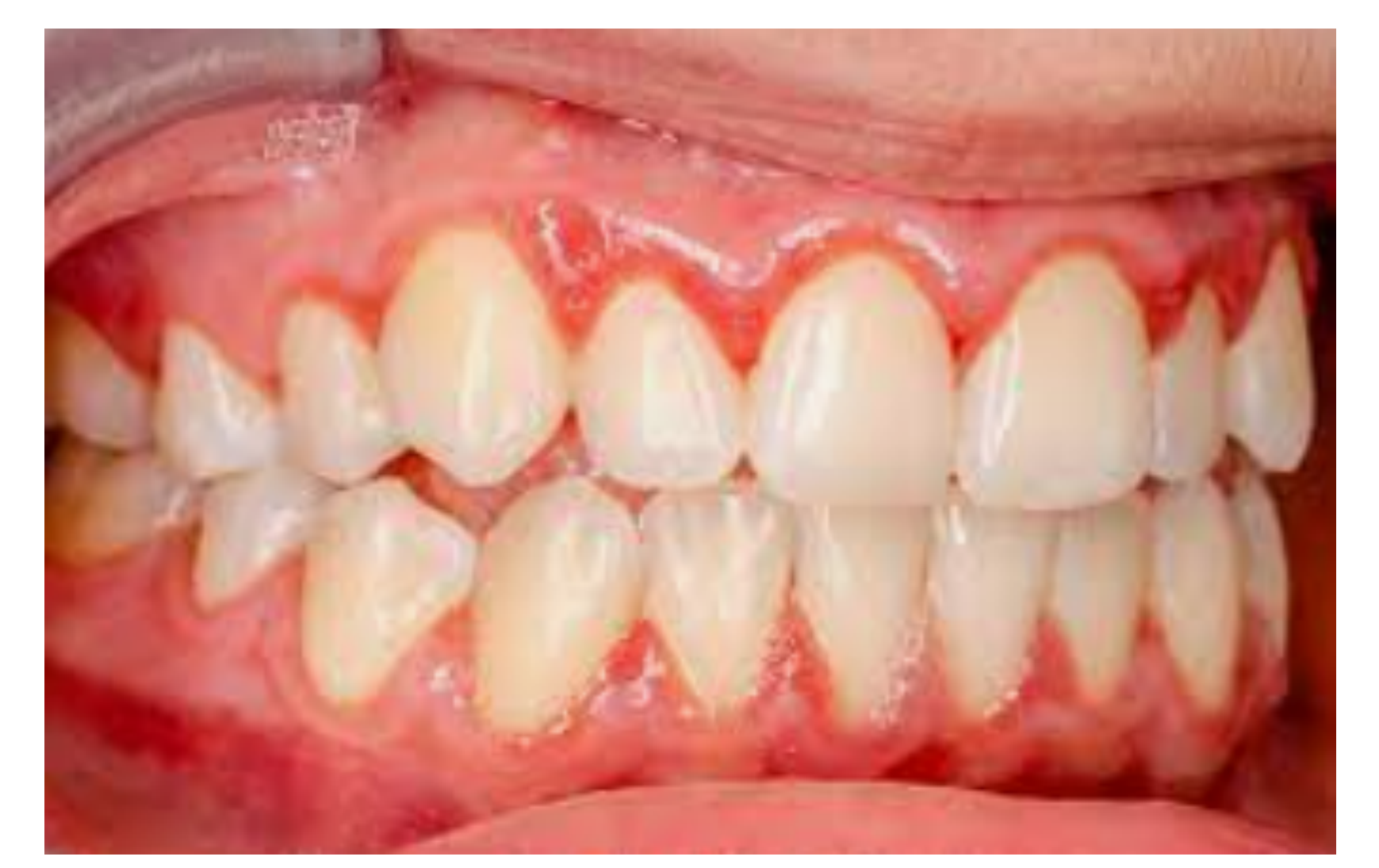 Desquamative gingivitis in a patient with auto-immune disease