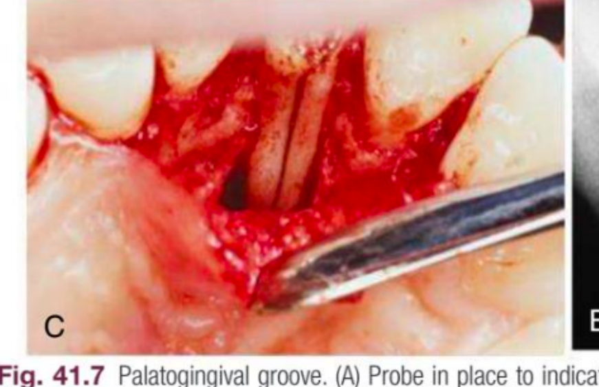 (C) The area is surgically opened. Note the palatogingival groove along the entire palatal portion of the root.