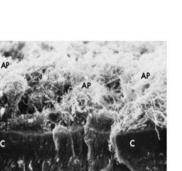 (B) Scanning electron photomicrograph of a cross-section of cementum (C) with attached subgingival plaque (AP). The area shown is within a periodontal pocket.