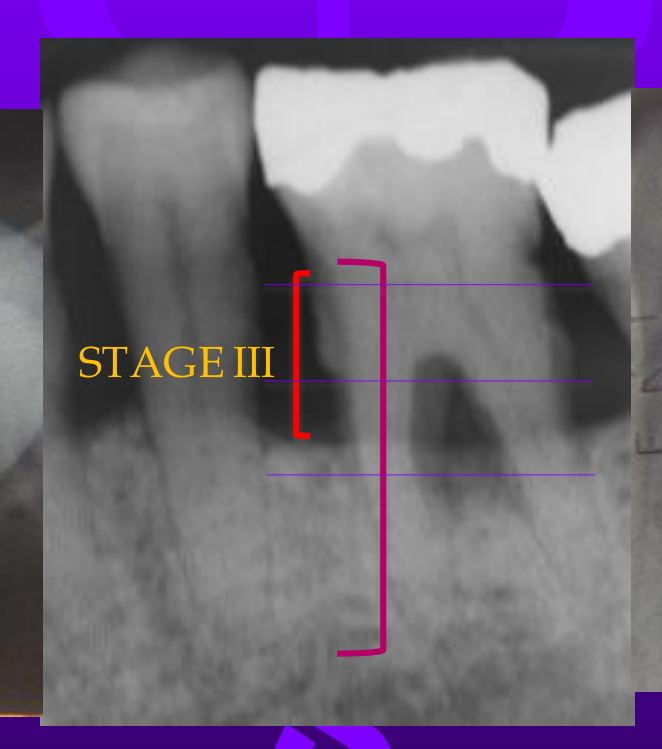 STAGE III