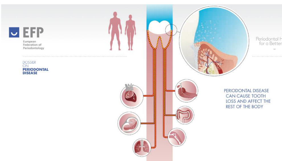 PERIODONTAL DISEASE CAN CAUSE TOOTH LOSS AND AFFECT THE REST OF THE BODY