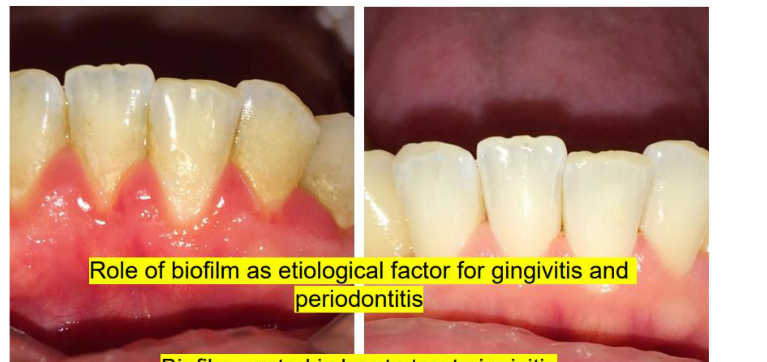 Role of biofilm as etiological factor for gingivitis and periodontitis Biofilm control is key to treat gingivitis Gingivitis treatment is a key preventive measure of periodontitis