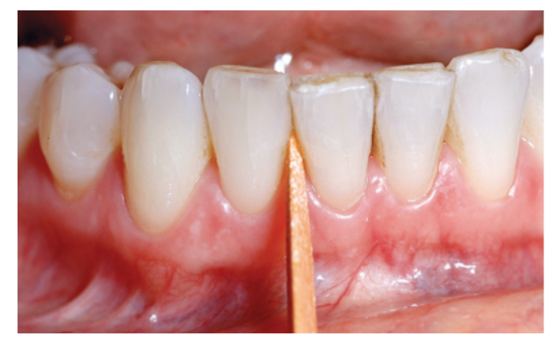 Interdental cleaning: Wood sticks