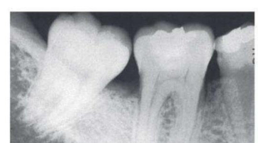 Fig. 39.24 Early furcation involvement suggested by fuzziness in the furcation of the mandibular first molar, particularly when associated with bone loss on the roots.