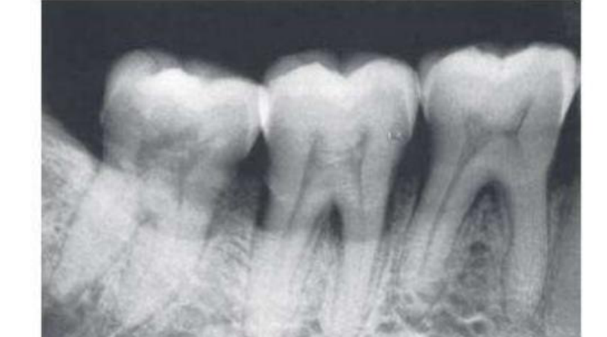 Fig. 39.25 Furcation involvement of mandibular first and second molars indicated by thickening of the periodontal space in the furcation area. The furcation of the third molar is also involved, but the thickening of the periodontal space is partially obscured by the external oblique line.