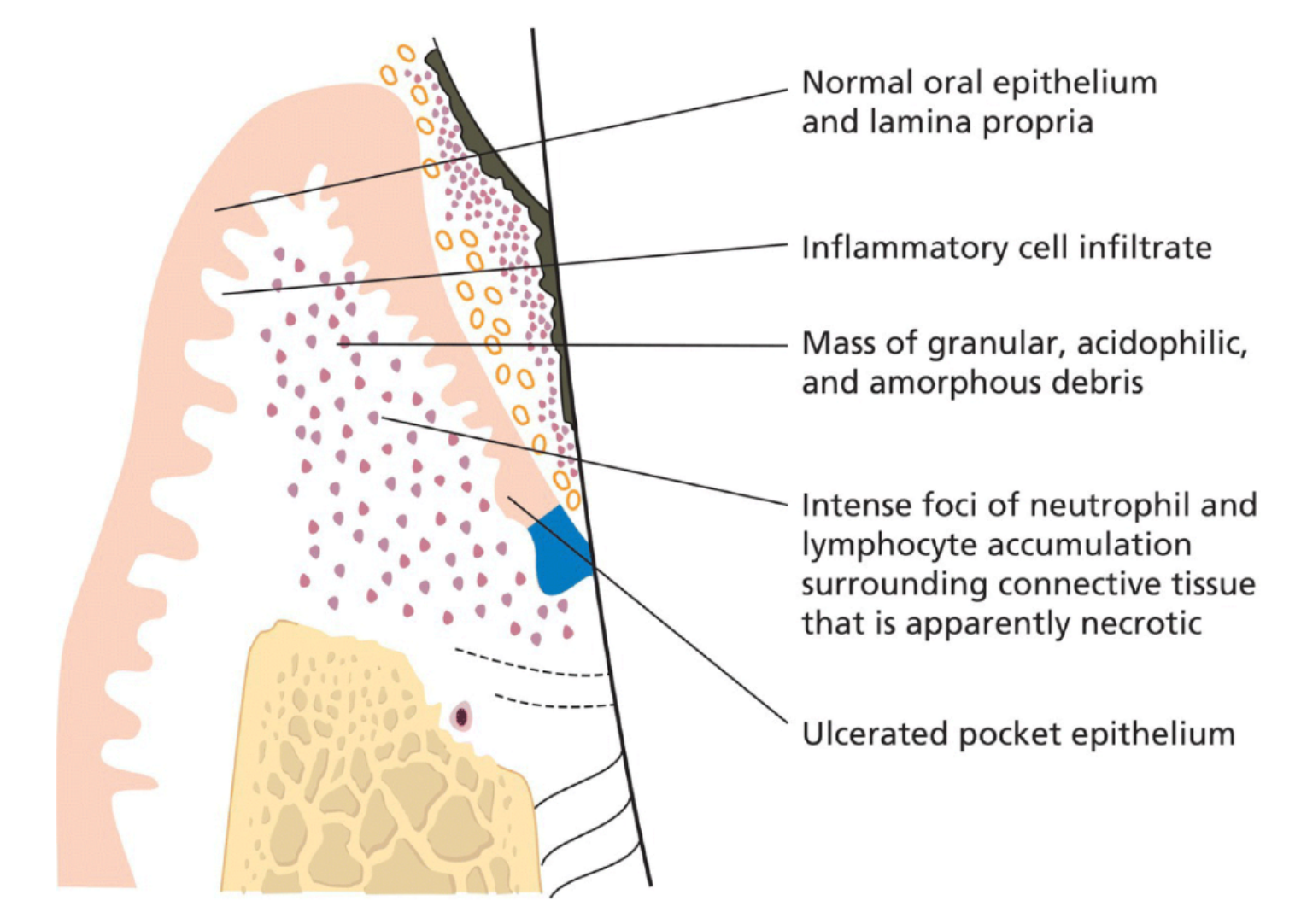Periodontal abscess
