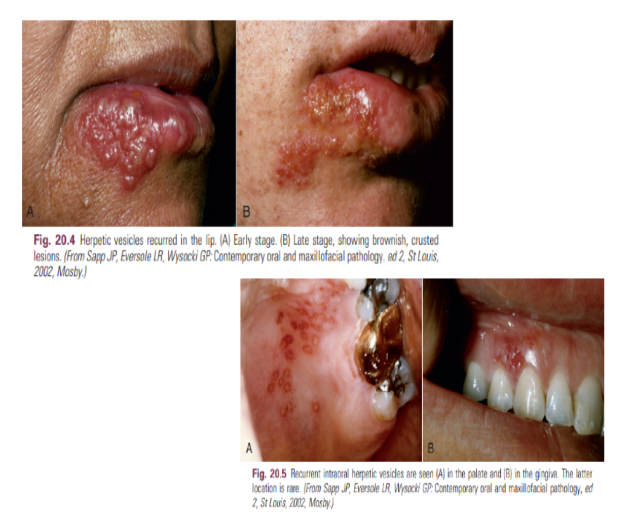 Fig. 20.4 Herpetic vesicles recurred in the lip. (A) Early stage. (B) Late stage, showing brownish, crusted lesions. (From Sapp JP, Eversole LR, Wysocki GP. Contemporary oral and maxillofacial pathology. ed 2, St Louis, 2002, Mosby.) Fig. 20.5 Recurrent intraoral herpetetic vesicles are seen (A) in the palate and (B) in the gingiva. The latter location is rare. (From Sapp JP, Eversole LR, Wysocki GP. Contemporary oral and maxillofacial pathology, ed 2, St Louis, 2002, Mosby.)