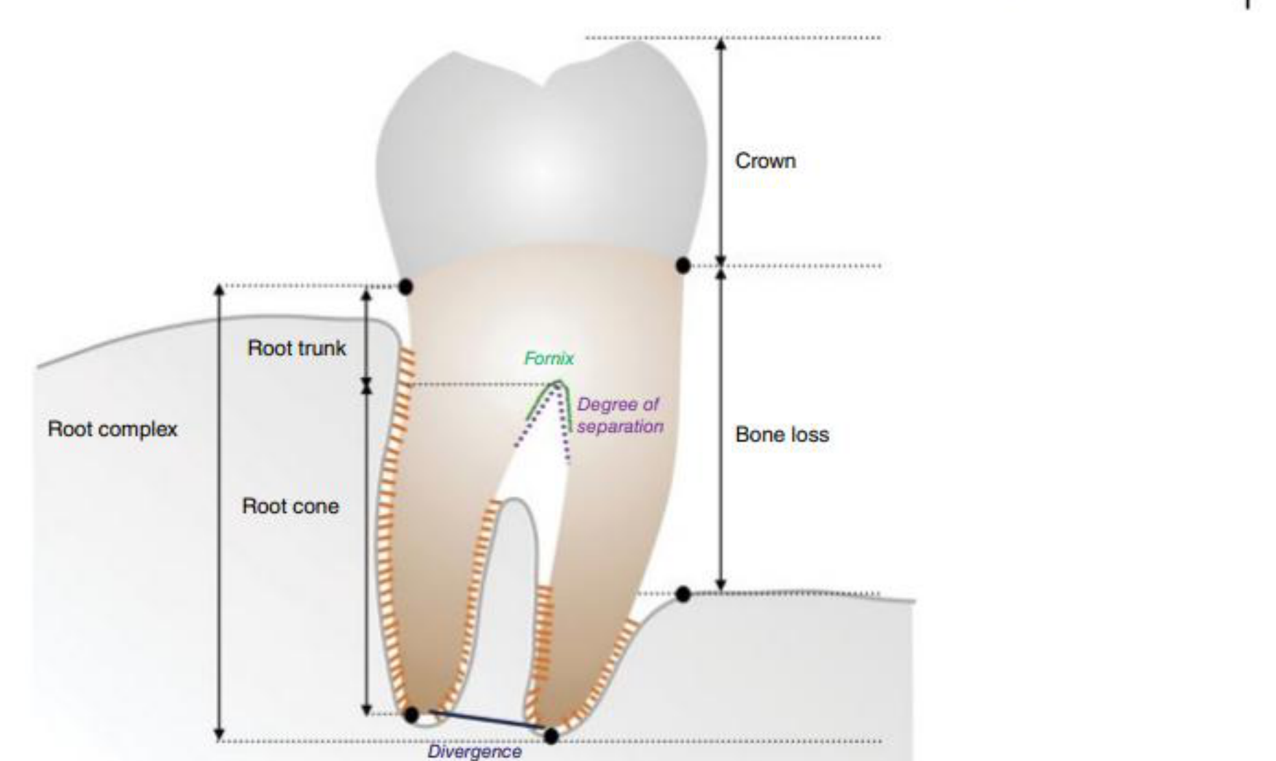 Figure 1.1 Drawing of mandibular molar with furcation involvement, showing the main anatomical features, including root trunk (part of the root from the cemento-enamel junction CEJ to the furcation entrance) and root cones, and pointing at root divergence and degree of separation between roots. The 'bone loss' is schematically indicated as the distance between the CEJ and the most apical part of the bone. Source: Courtesy of Dr Aliye Akcali.