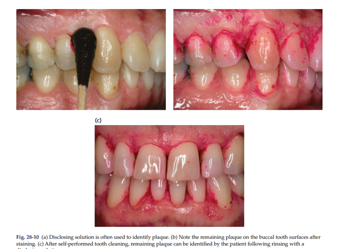 Fig. 28-10 (a) Disclosing solution is often used to identify plaque. (b) Note the remaining plaque on the buccal tooth surfaces after staining. (c) After self-performed tooth cleaning, remaining plaque can be identified by the patient following rinsing with a disclosing solution.