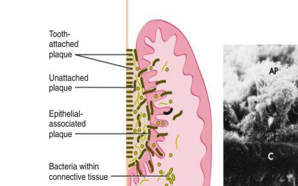 Fig. 10.2 Subgingival plaque. (A) Diagram depicting the plaque–bacteria association between the tooth surface and the periodontal tissues.