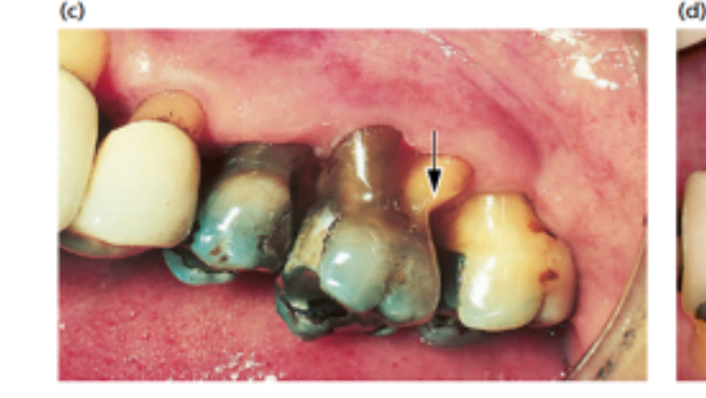 (c) Hard tissue damage has resulted after extensive use of interdental brushes.
