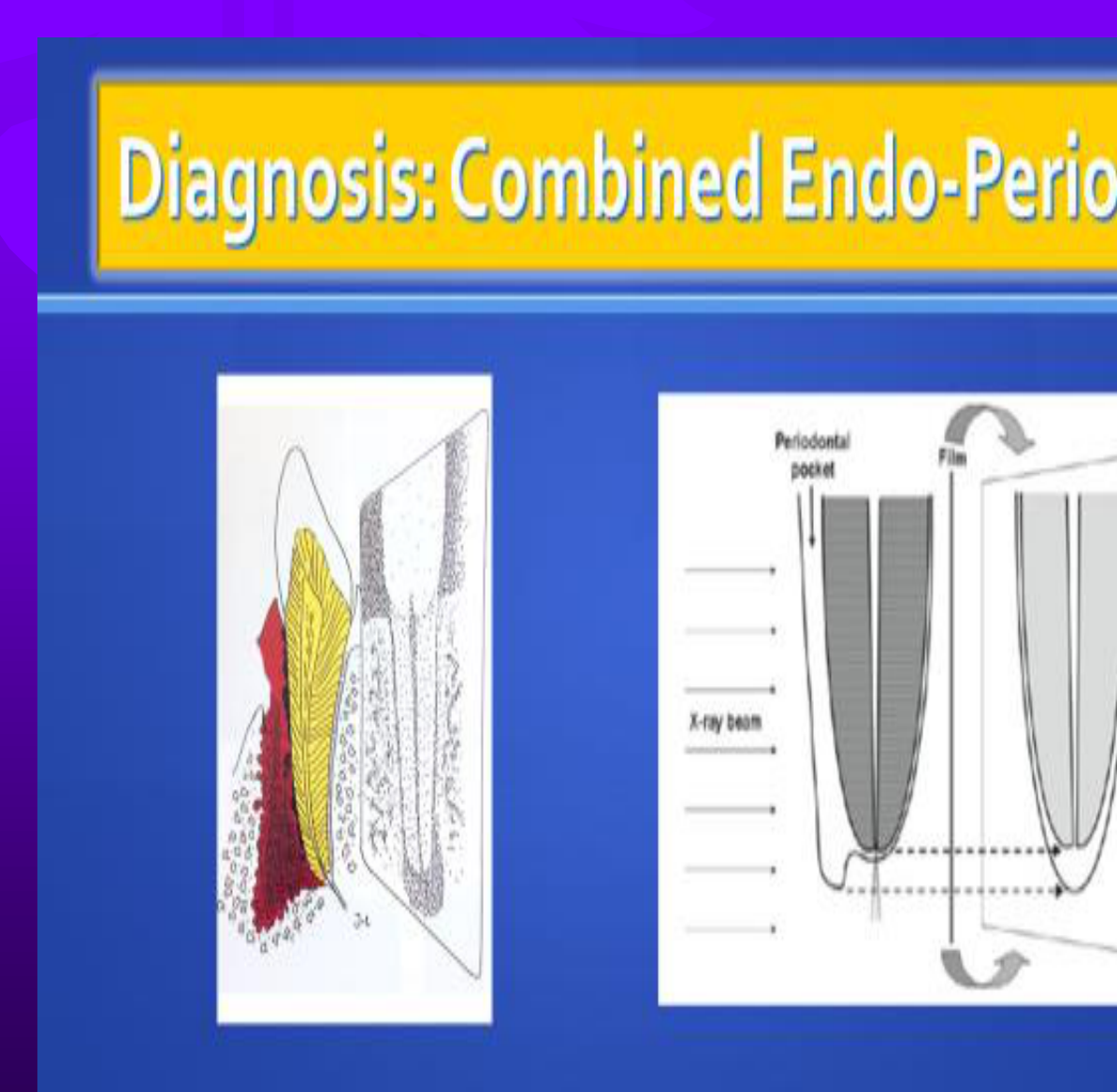Diagnosis: Combined Endo-Perio?