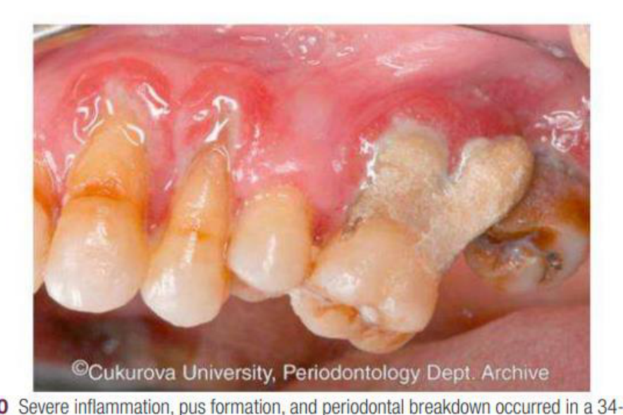eFig. 7.110 Severe inflammation, pus formation, and periodontal breakdown occurred in a 34-year-old man with uncontrolled type 1 diabetes mellitus.