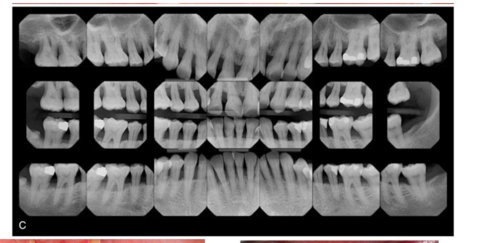 Fig. 41.2 Generalized, stage III, grade C periodontitis in a healthy, nonsmoking 49-year-old female. (A and B), Moderate clinical biofilm, calculus, and gingival inflammation. (C) Moderate to severe radiographic bone loss. Overall prognosis is questionable/unfavorable. (Copyright Jonathan H. Do, DDS. All rights reserved.)