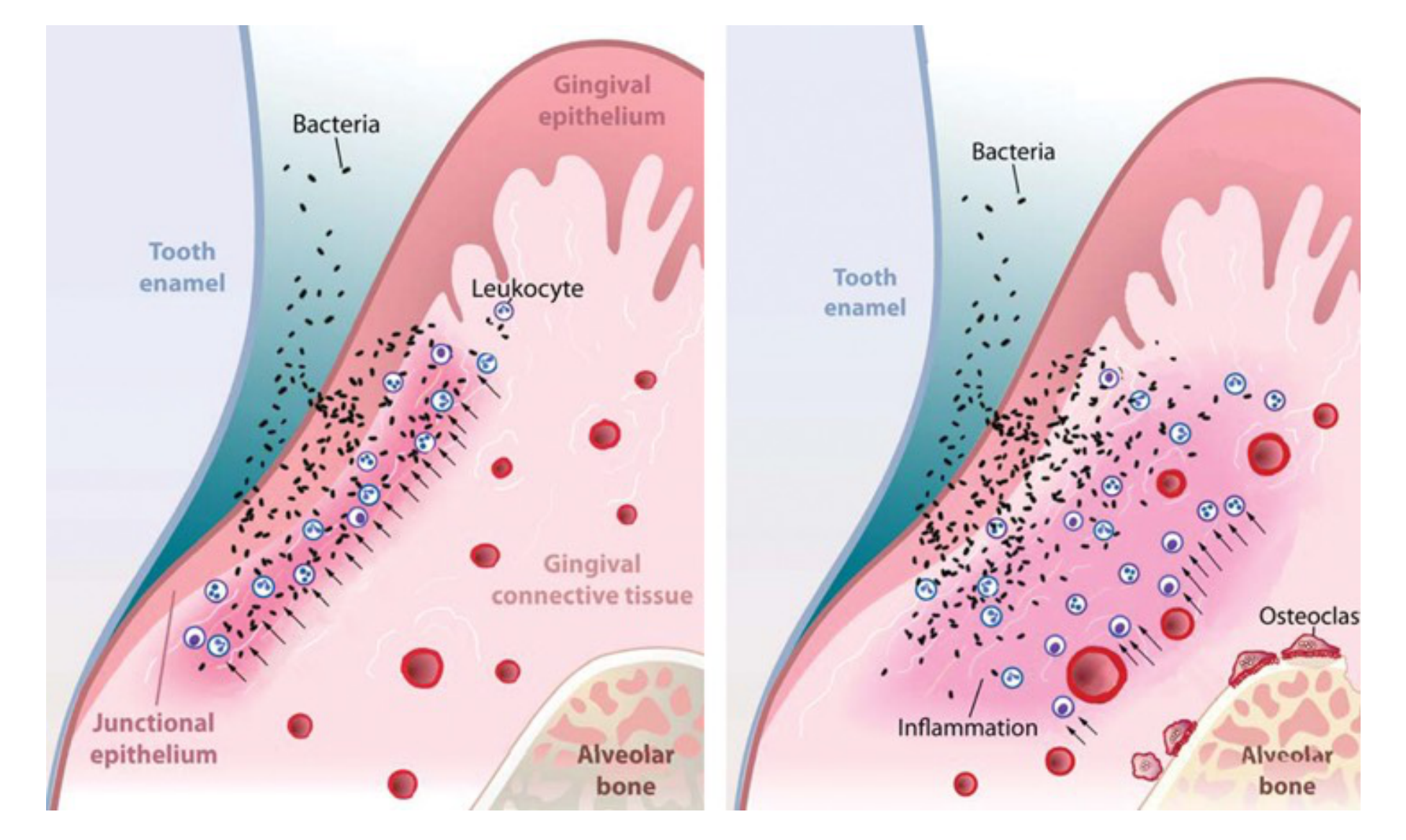 Periodontal abscess