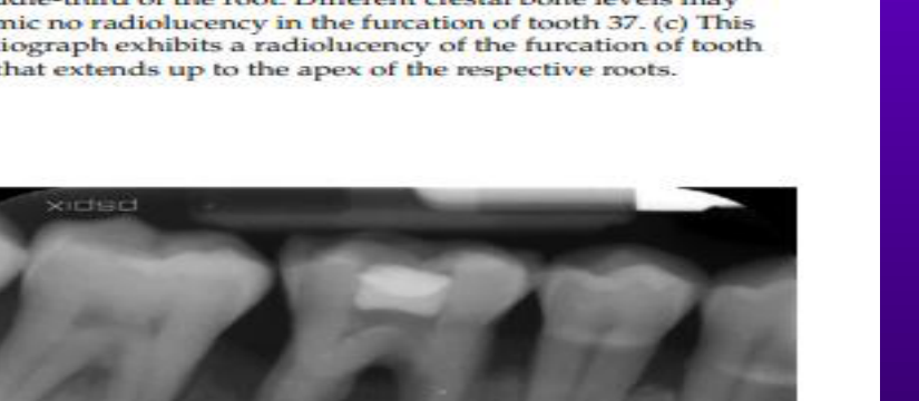 Fig. 23-20 This periapical image shows an extended radiolucency from the alveolar crest to the periapical region of tooth 46. This points towards the presence of periodontal and periapical inflammatory pathologies (perio-endo lesion).