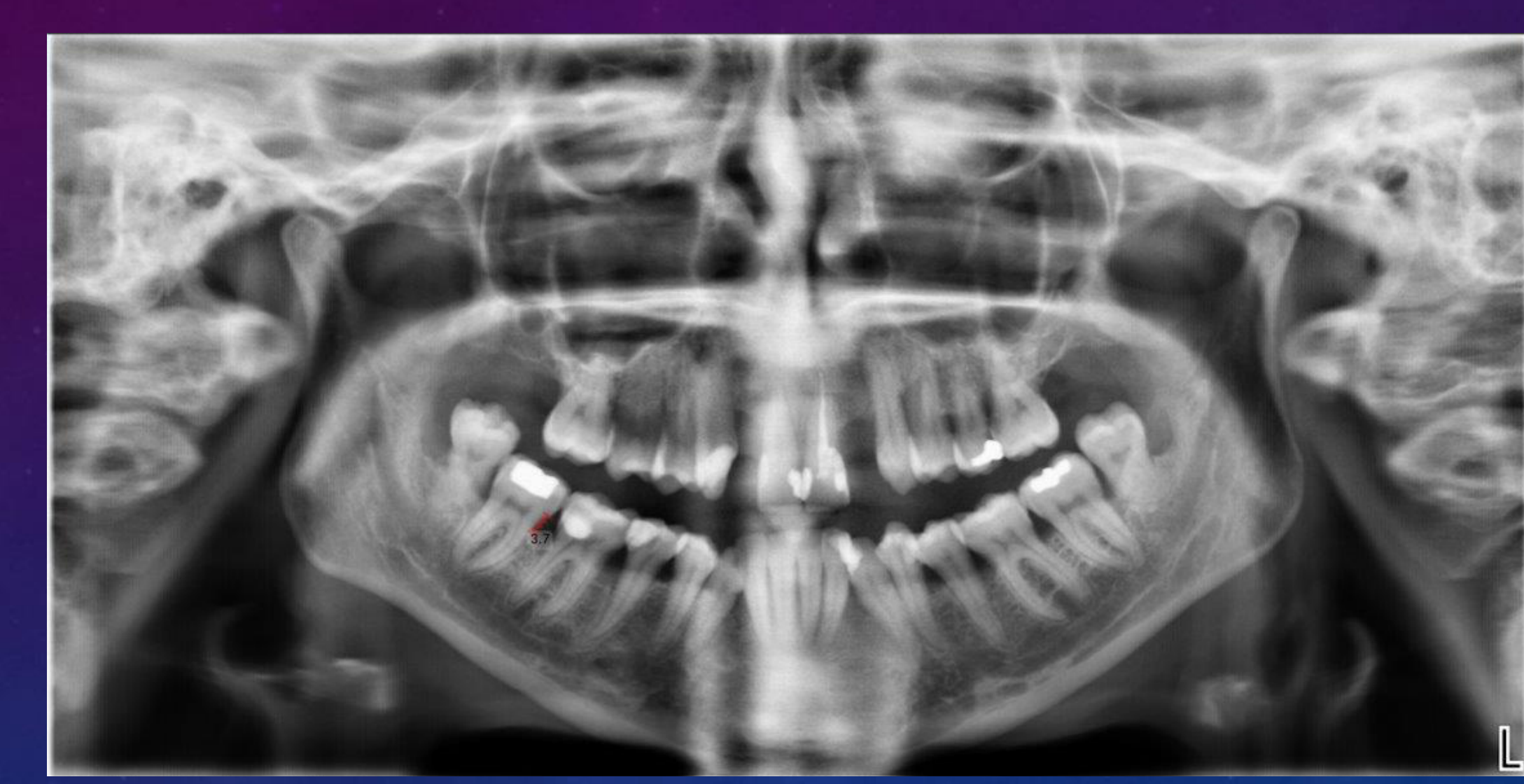 PANORAMIC RADIOGRAPH: