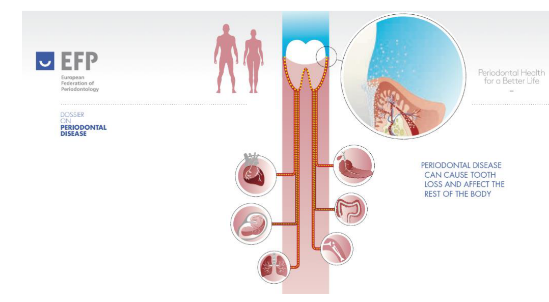 EFP Dossier on Periodontal Disease: Periodontal Health for a Better Life. Periodontal disease can cause tooth loss and affect the rest of the body.