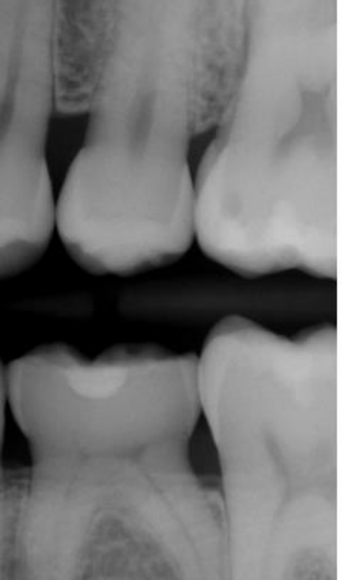 Fig. 11. Stage 1 Periodontal Disease (mandibular + maxillary right posterior) bitewing radiograph: Radiographic bone loss limited to the coronal third (<15%). Image provided by authors.