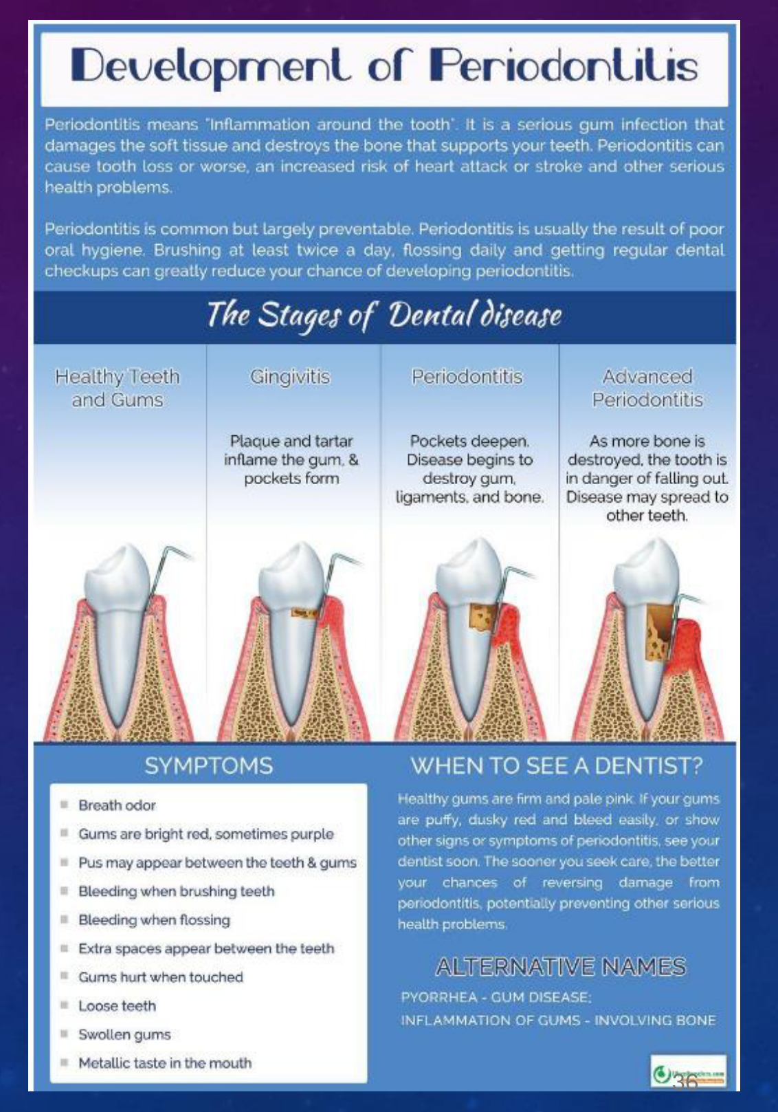 Development of Periodontitis / The Stages of Dental disease