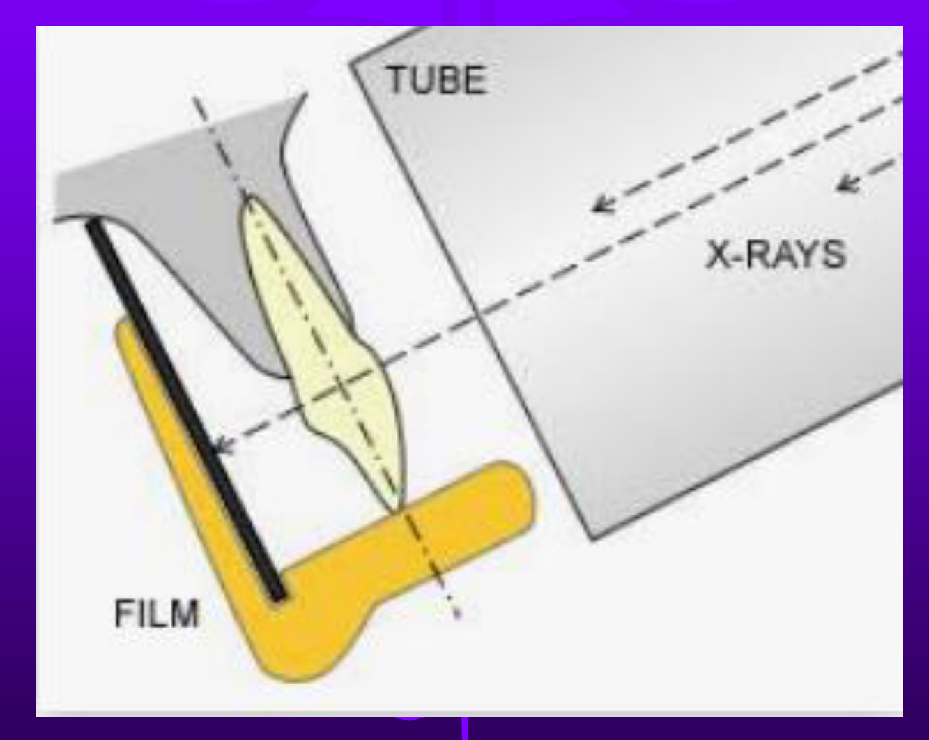 Long cone parallel technique