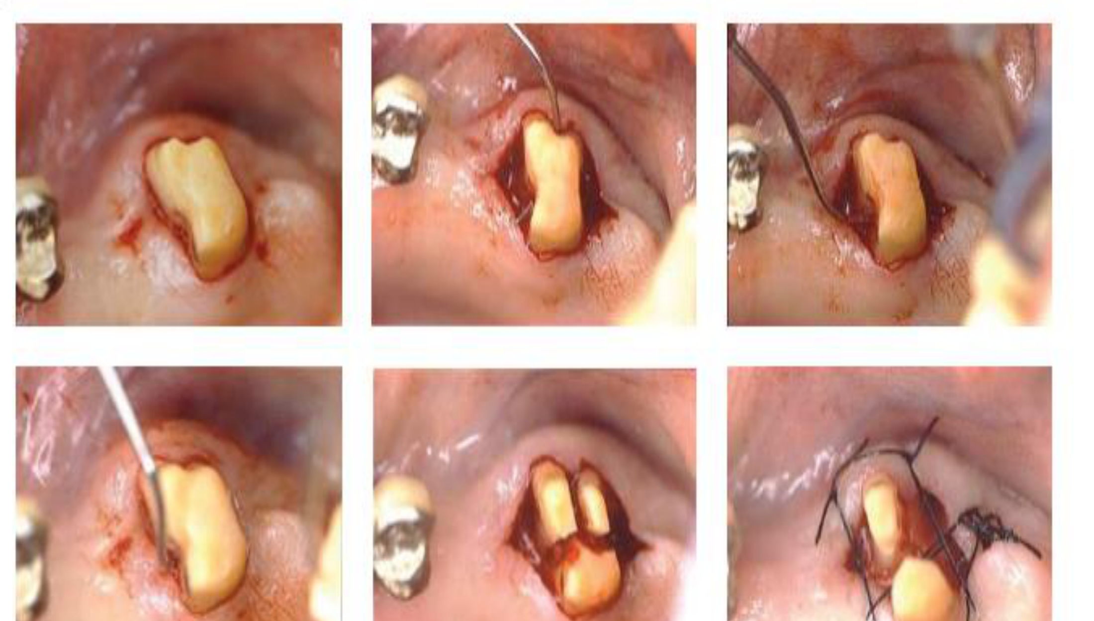 Figure 8.3 Root separation of all three roots of a maxillary upper second molar and extraction (rizectomy) of the disto-buccal root.