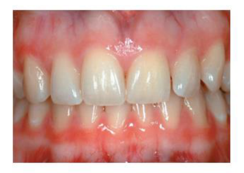 Figure 8.3 Clinically healthy gingiva in a 19-year-old female.