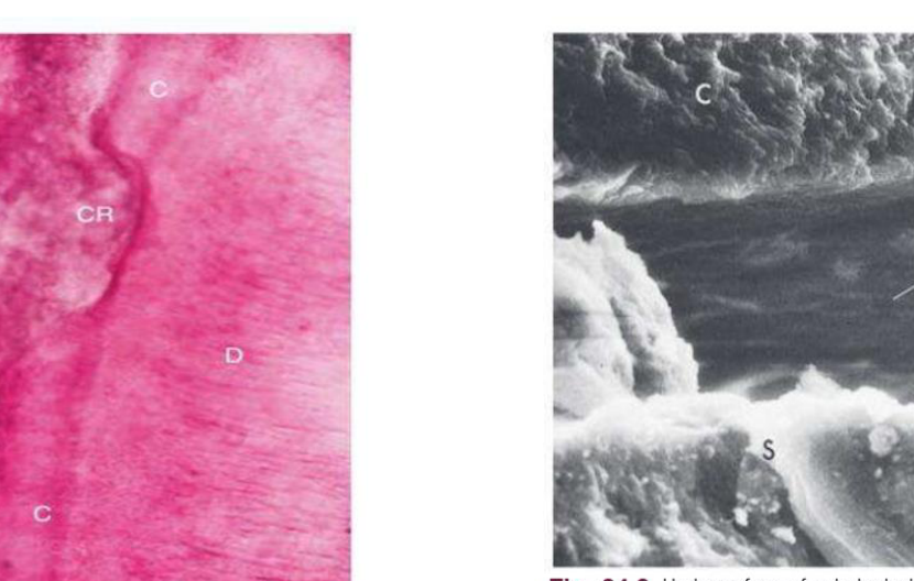 Fig. 24.8 Calculus (CA) attached to a cemental resorption area (CR) with cementum (C) adjacent to dentin (D). (Courtesy Dr. Erwin Schaffer, Minneapolis, MN.)