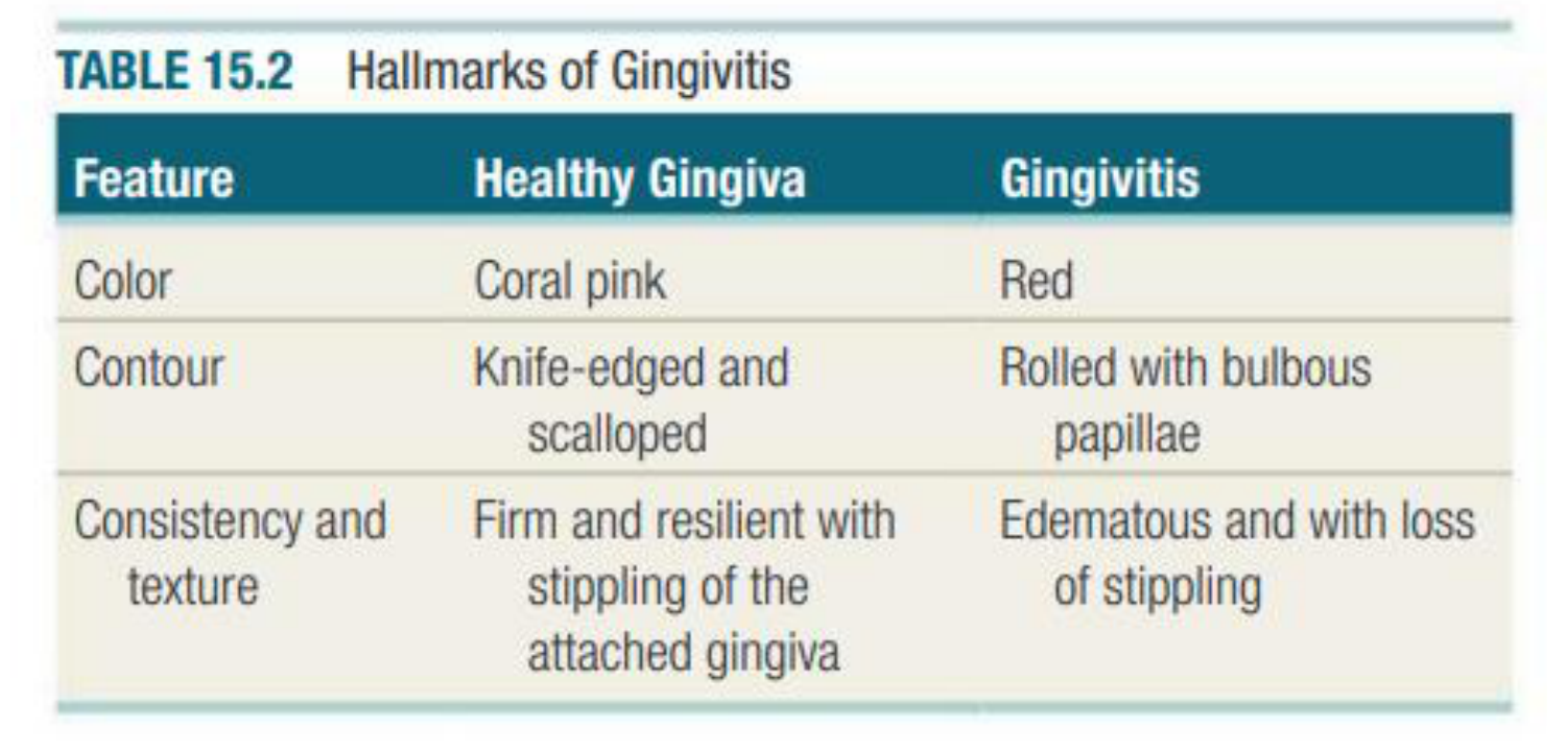 TABLE 15.2 Hallmarks of Gingivitis