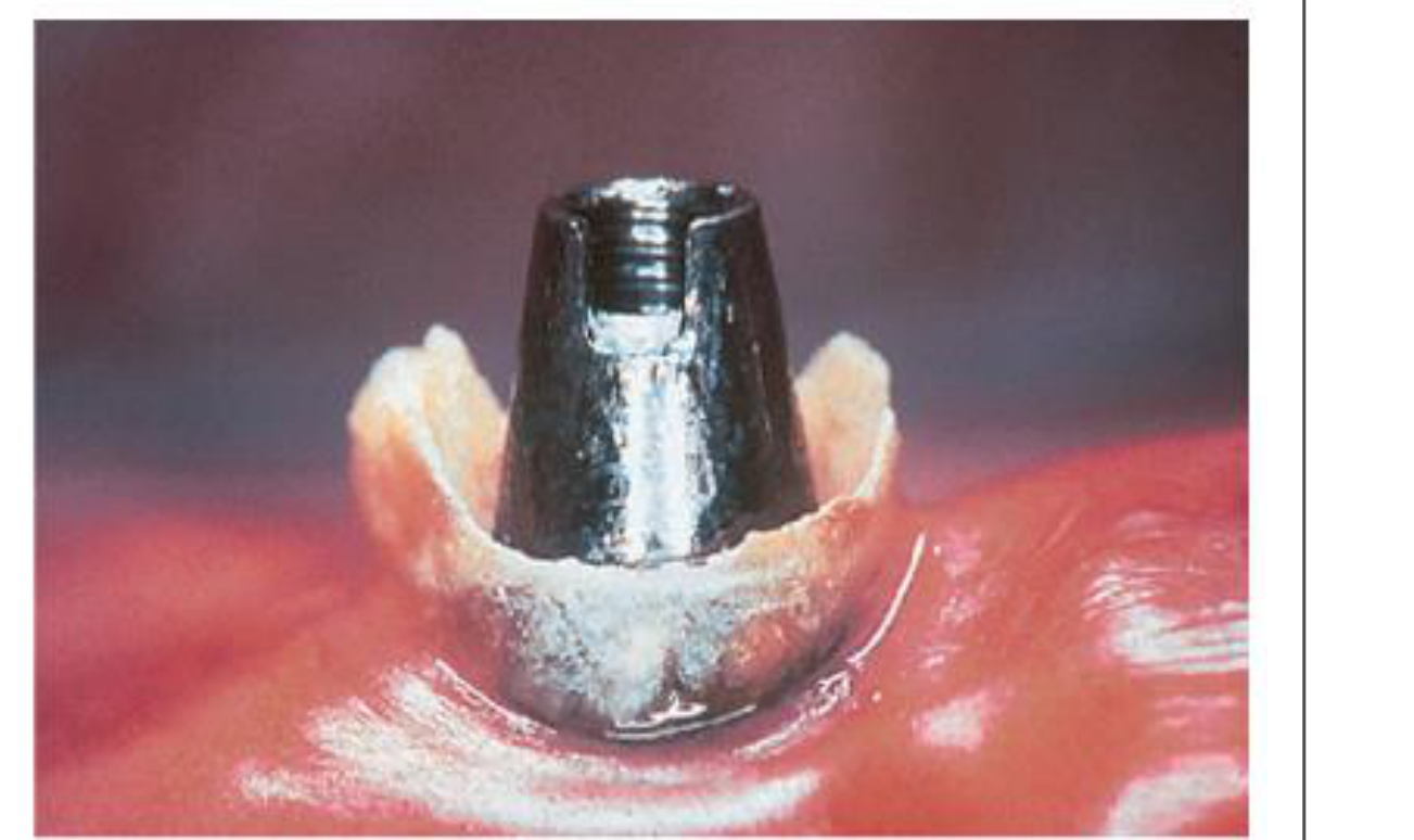 Fig. 8-22 Calculus deposit on an oral implant in a patient without regular maintenance care.