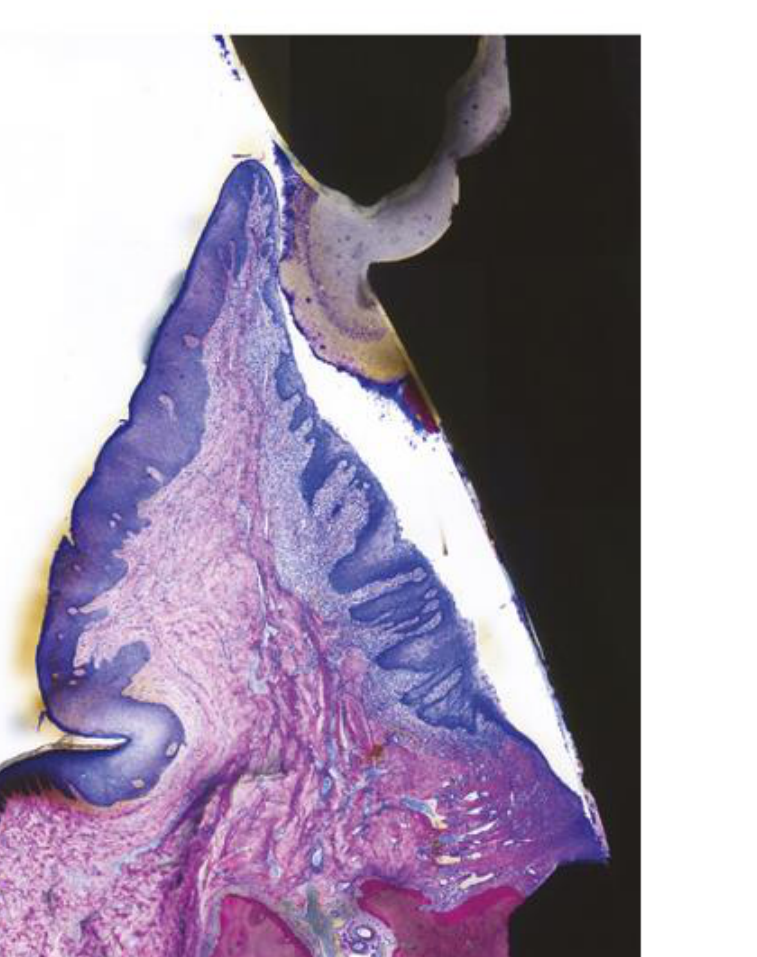 Fig. 8-23 Excess cement at the abutment-crown interface provides an ideal substrate for biofilm and calculus deposition and retention. Bacterial biofilm covers the entire surface of the cement, whereas calculus is present apical to the cement overhang. Detachment of the epithelium indicates pocket formation. The detachment of the apical-most portion of the epithelium, however, may represent an artifact due to histologic processing. Underdecalfied ground section.