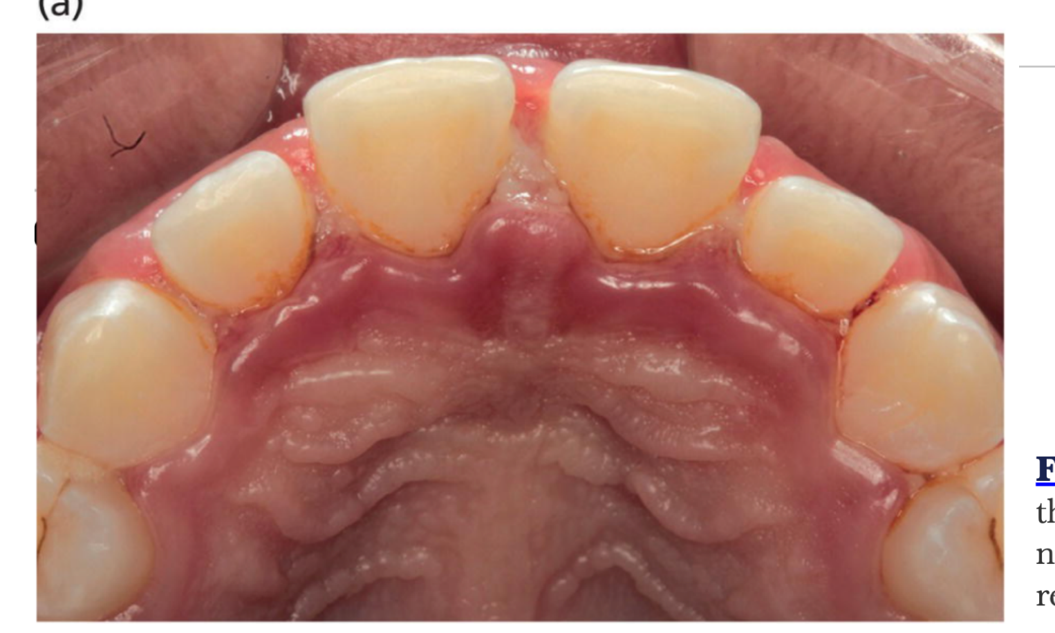 (a) Active lesions with necrosis the interdental papillae.