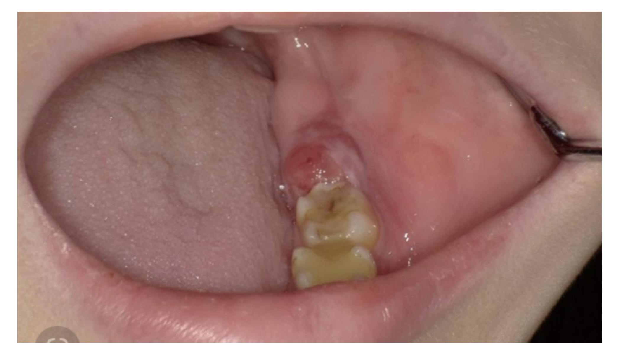 Neoplasia