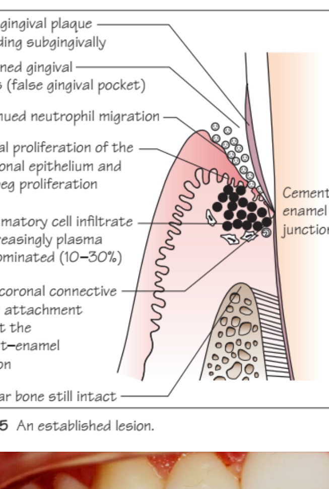 Figure 8.5 An established lesion.