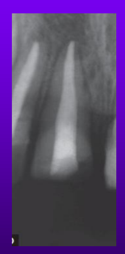 A perfect rootfilling?