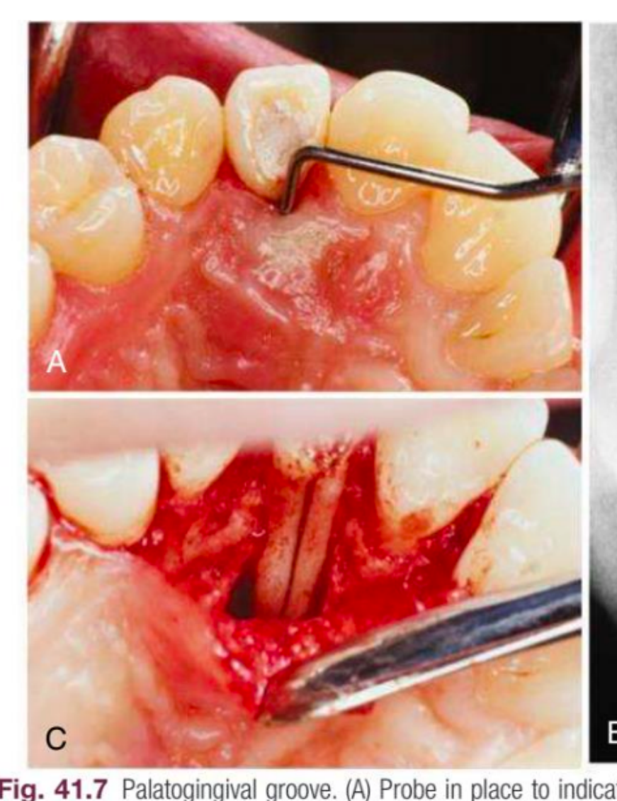 Fig. 41.7 Palatogingival groove. (A) Probe in place to indicate a deep pocket along the palatogingival groove.