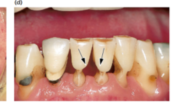 (d) Hard tissue damage (arrows) has resulted after extensive use of interdental brushes.