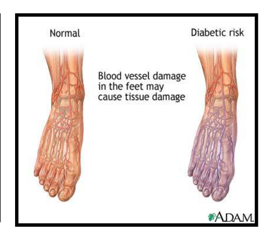 Blood vessel damage in the feet may cause tissue damage