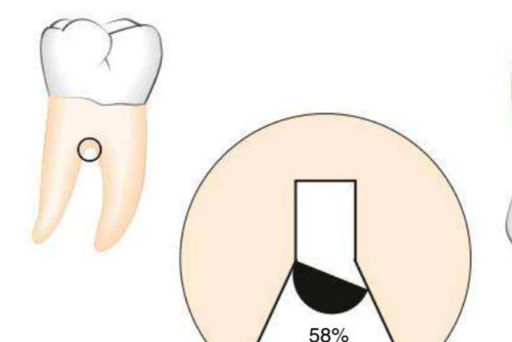 Fig. 41.8 The furcation entrance is narrower than a standard curette in 58% of first molars. (Redrawn from Bower RC. Furcation morphology relative to periodontal treatment. Furcation root surface anatomy. J Periodontol. 1979;50:366.)