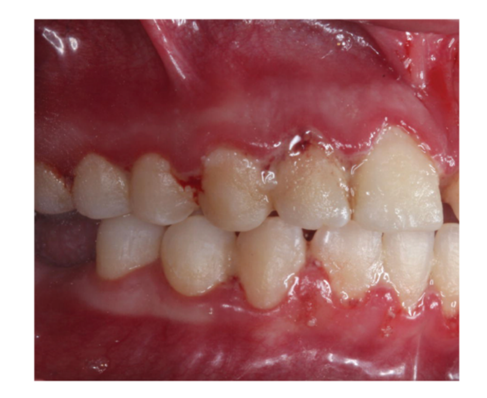 Fig. 19-7 Necrotizing gingivitis in a 22-year-old woman: bleeding, necrosis, and pseudomembrane can be observed.