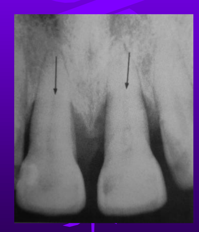 RADIOPAQUE HORIZONTAL LINE FOR LABIAL OR LINGUAL BONE LEVEL