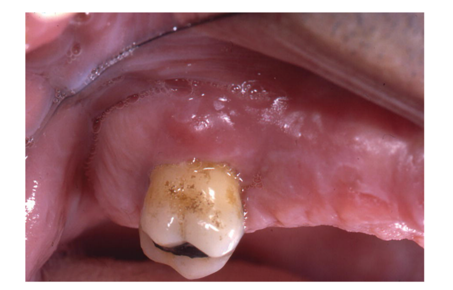 Fig. 19-5 Periodontal abscess associated with an upper right third molar. Note how this lesion is associated with tooth extrusion and mobility.