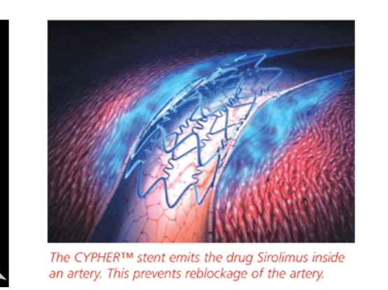 The CYPHER™ stent emits the drug Sirolimus inside an artery. This prevents reblockage of the artery.