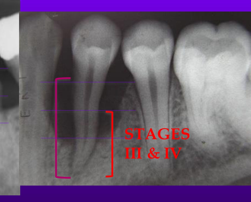 STAGES III & IV