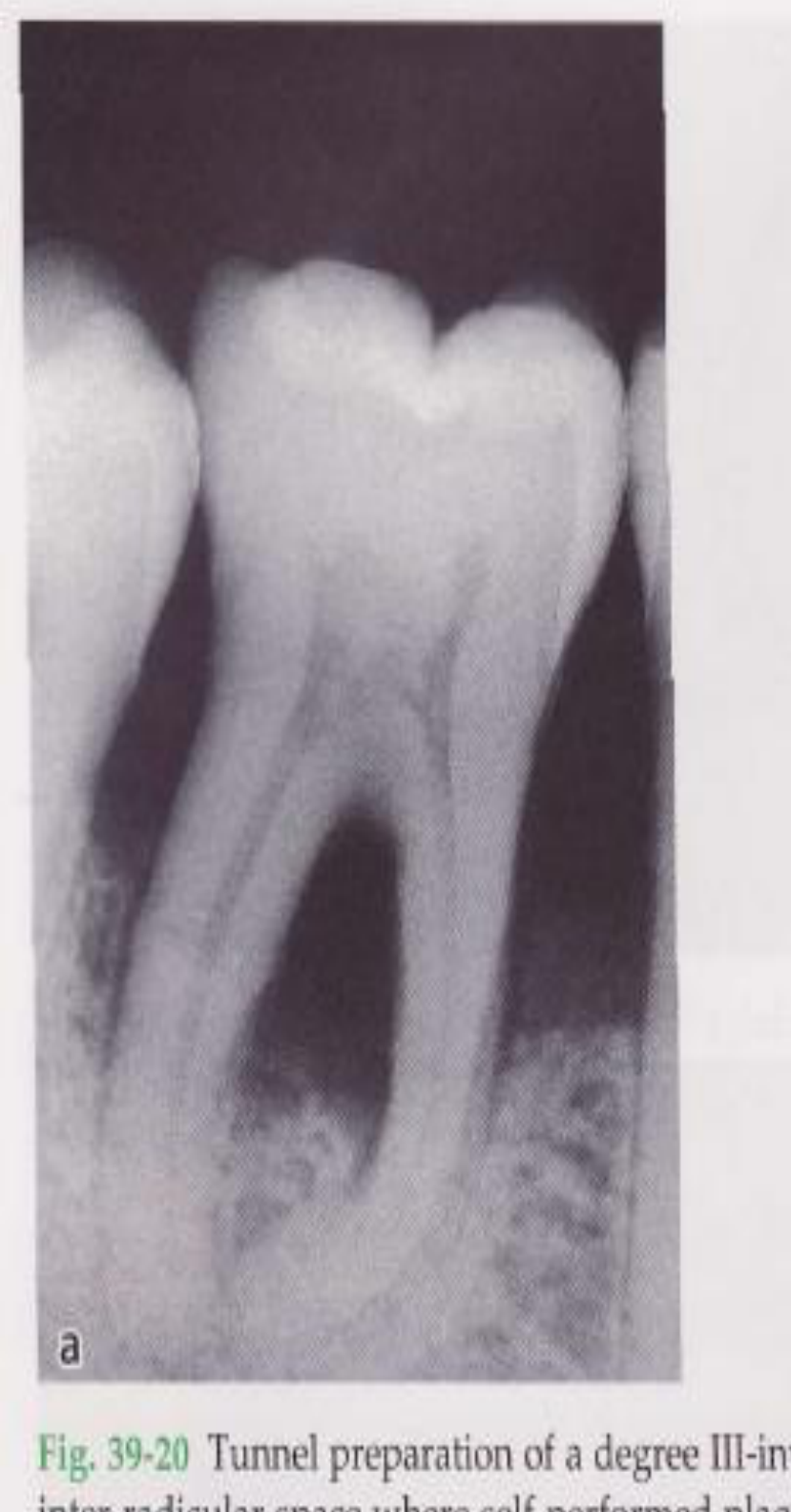 Fig. 39-20 Tunnel preparation of a degree III-involved mandibular molar.
