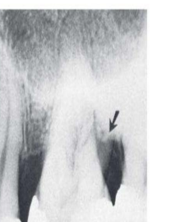 Fig. 39.26 Furcation involvement of the first molar partially obscured by the radiopaque lingual root. The horizontal line across the distobuccal root demarcates the apical portion (arrow), which is covered by bone, from the remainder of the root, where the bone has been destroyed.