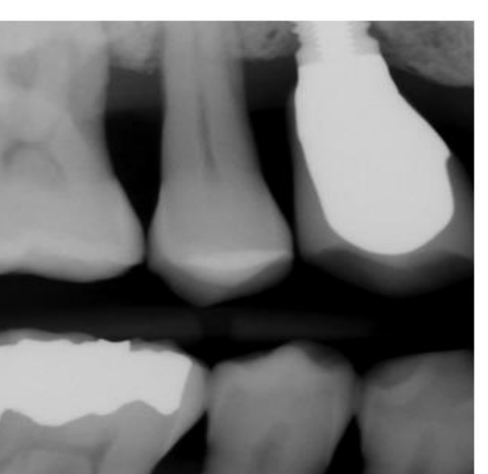 Fig. 14. Stage 3 Periodontal Disease (mandibular + maxillary right posterior) bitewing radiograph: Radiographic bone loss extending to the middle third of root and beyond. Fucation involvement class II and class III. Image provided by authors.